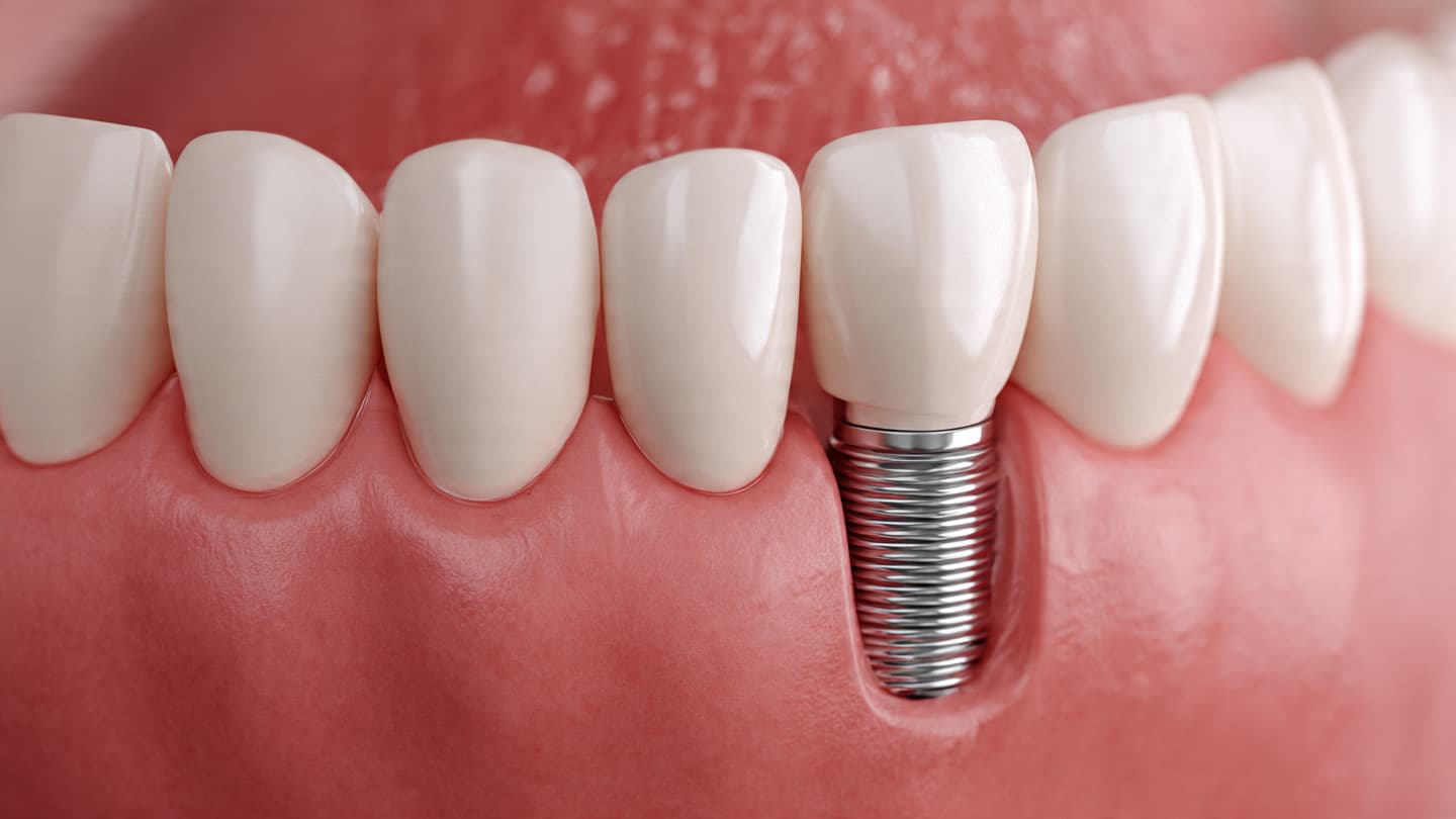 Dental Implants vs. Bridges: Which Is Right For You? | Endo Smile Dental Care additional image 1