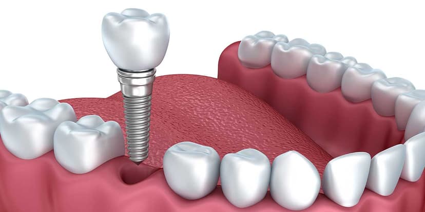 Dental Implants & Fillings
