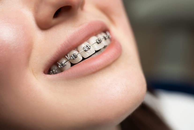 Braces & Clear Aligners