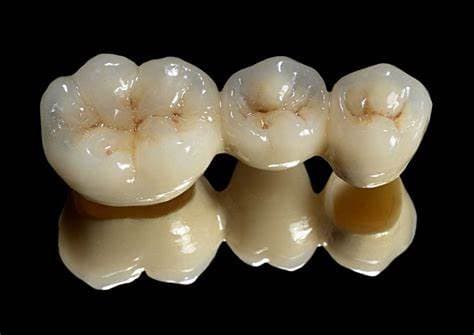 Crowns & Fixed Bridges