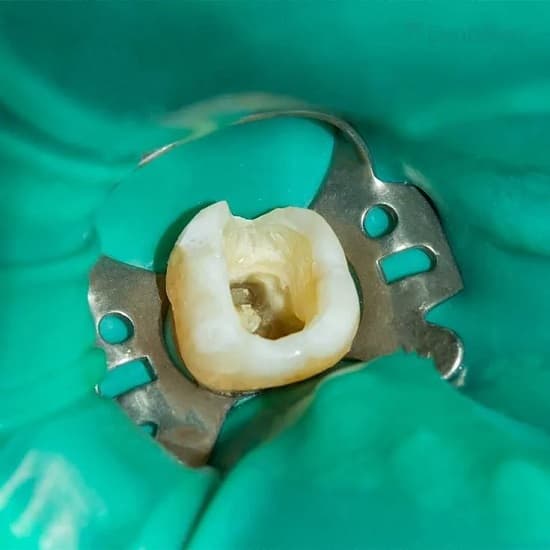 Painless Root Canal Treatment